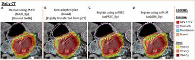 Impact of Using Unedited CT-Based DIR-Propagated Autocontours on Online ART for Pancreatic SBRT